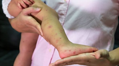 Brote de sarampión: ya son 26 los casos confirmados