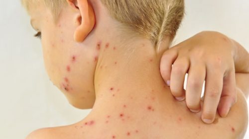 La OMS en alerta por el aumento de casos de sarampión en Europa