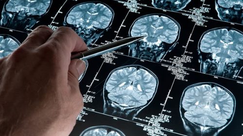 Descubren un gen protector del Alzheimer y desarrollan una plataforma rápida de pruebas para un fármaco