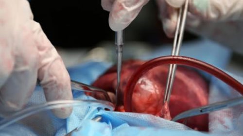Realizaron más de 1.000 trasplantes de órganos en lo que va del año en el país