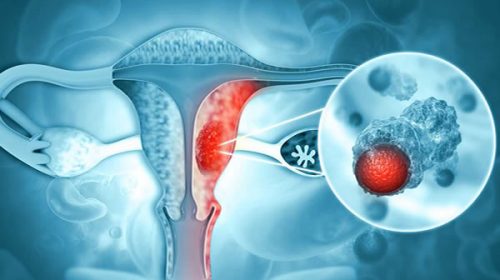 Salud promueve la detección temprana del Cáncer de Cuello de Útero