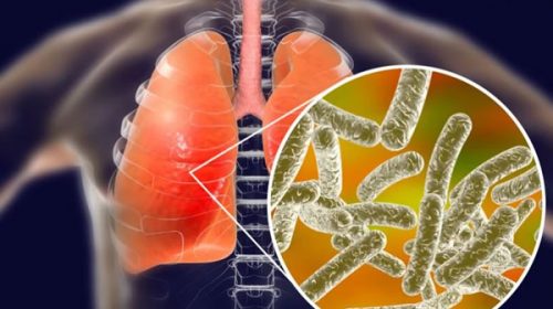 Brote de Legionella en Tucumán: ya son 22 los afectados, de los cuales 6 murieron