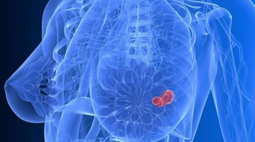 Cáncer de mama: una nueva droga disminuye en un 30% el riesgo de recurrencia