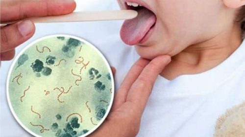 Alarma por casos de Streptococcus pyogenes: contagio, síntomas y todo lo que tenés que saber