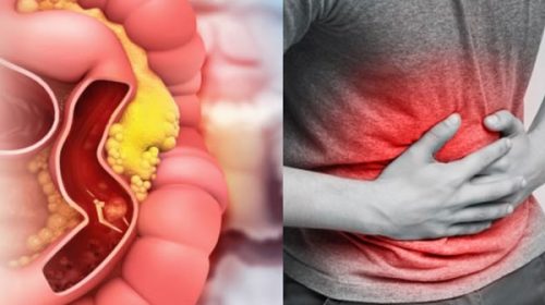 Iosper presentó el Programa de prevención de cáncer de colon Iosper presentó el Programa de prevención de cáncer de colon