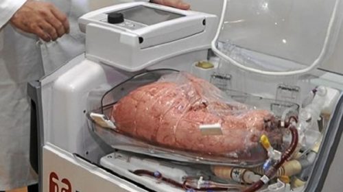 Por primera vez en Argentina realizaron dos trasplantes renales con máquinas de perfusión Por primera vez en Argentina realizaron dos trasplantes renales con máquinas de perfusión