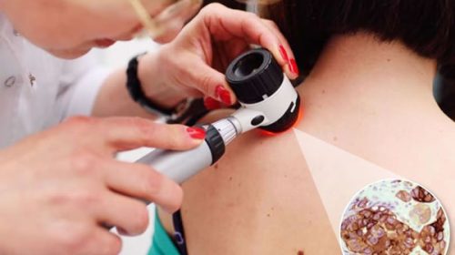 Una vacuna argentina contra el cáncer de piel demostró una alta eficacia para los casos más graves Una vacuna argentina contra el cáncer de piel demostró una alta eficacia para los casos más graves