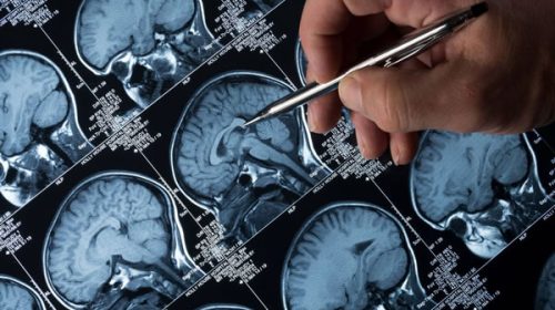 EEUU aprobó el segundo medicamento contra el Alzheimer: cómo funciona