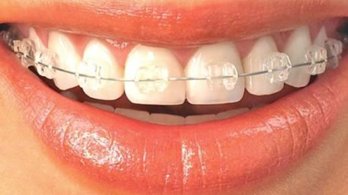 La ANMAT prohibió el uso y venta de unos brackets por considerarlos un grave riesgo para la salud