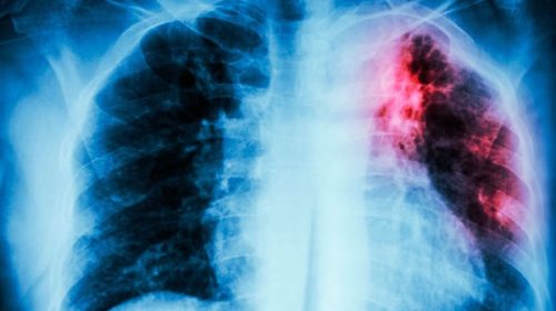 Aumentan los casos de tuberculosis en Córdoba: piden reforzar las medidas de prevención