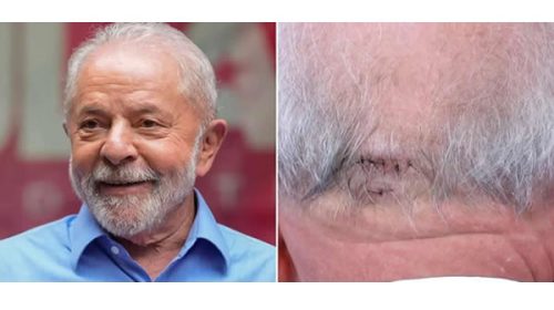 ¿Cómo se encuentra Lula tras ser operado de urgencia?