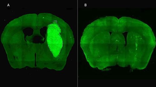 Especialistas del CONICET lograron frenar un tipo de cáncer cerebral con una novedosa estrategia terapéutica