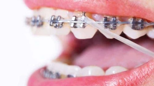 ANMAT prohibió la venta de brackets por peligro para la salud