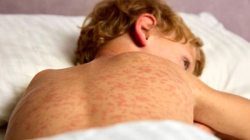 Alerta epidemiológica por nuevos casos de sarampión