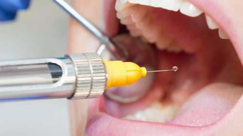 Retiran del mercado un anestésico odontológico tras una alerta de ANMAT