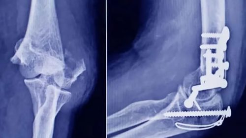 ANMAT prohibió un tornillo traumatológico usado en cirugías: cuáles son los peligros para la salud