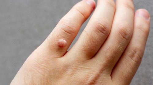 Anmat ordenó retirar del mercado un medicamento para tratar verrugas