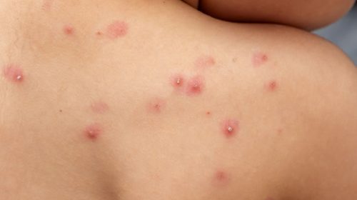 Primer caso en el país de una variante más contagiosa y severa de la viruela símica