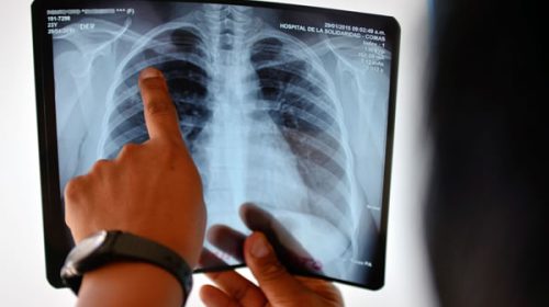 Alerta por tuberculosis: en lo que va de 2026 hubo 1.225 casos más que el promedio para esta época